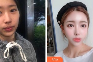 普宁伊丽莎白医疗美容诊所孙杰整形价格表附切开双眼皮案例展示