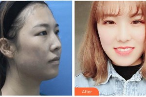 普宁伊丽莎白医疗美容诊所李铁军整形价格表附眼部手术案例展示