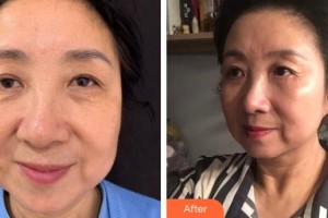 普宁市人民医院眼科黄伯健整形价格表附内切祛眼袋案例展示