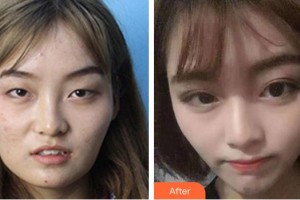 普宁市人民医院眼科余杰克整形价格表附眼部综合案例展示