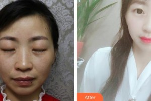 普宁市人民医院眼科蔡伟彬整形价格表附眼部综合案例展示