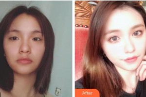 普宁市人民医院眼科李焕生整形价格表附切开双眼皮案例展示