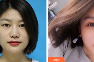 广空后勤医院整形美容中心黄社栋整形价格表附眼部综合案例展示