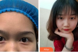 广空后勤医院整形美容中心张静整形价格表附切开双眼皮案例展示