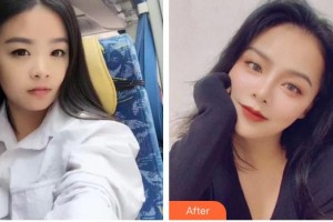 广空后勤医院整形美容中心刘峰整形价格表附眼部综合案例展示