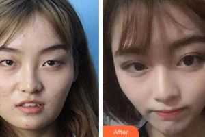 广空后勤医院整形美容中心冼纪雯整形价格表附眼部综合案例展示