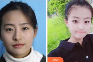 广空后勤医院整形美容中心肖美玲整形价格表附眼部综合案例展示