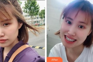 西昌玥美整形美容医院汤颖峰整形价格表附金属托槽矫正案例展示