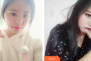 南昌爱尔眼科医院幸正茂整形价格表附眼部综合案例展示