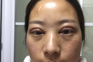 徐州医科大学附属医院环境怎么样双眼皮手术果分享附价格一览