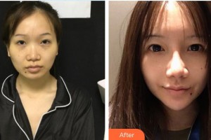 东南大学附属中大医院整形外科郭宗科整形价格表附垫鼻基底案例展示