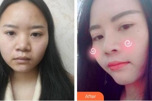 东南大学附属中大医院整形外科王磊整形价格表附鼻部综合案例展示