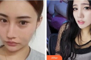 皖南医学院弋矶山医院整形外科潘勇整形价格表附鼻部综合】案例展示