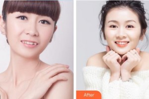 北医整形美容外科门诊部刘文华整形价格表附牙齿陶瓷矫正案例展示