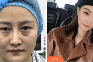 咸阳爱尔眼科医院周善文整形价格表附切开双眼皮案例展示