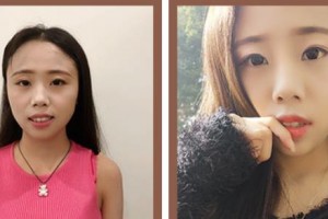 瑞安雅正口腔门诊部叶洁整形价格表附牙齿隐形矫正案例展示