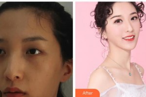 瑞安雅正口腔门诊部孔维展整形价格表附隐形托槽矫正案例展示