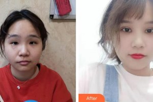 乳山新视力眼科医院张军富整形价格表附定点双眼皮例展示