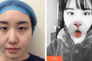 乳山新视力眼科医院初日旭整形价格表附眼部综合案例展示