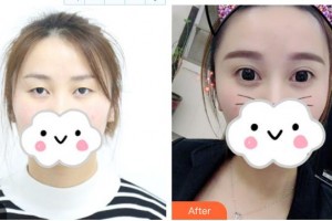 乳山新视力眼科医院王景文整形价格表附眼部综合案例展示