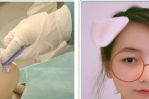 石狮宝岛栢丽医疗美容医院杨三香整形价格表附牙齿隐形矫正案例展示