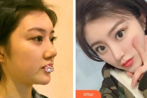 石狮宝岛栢丽医疗美容医院黄惠銘整形价格表附牙齿矫正案例展示