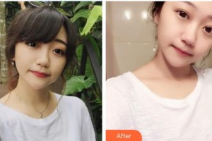 诸暨市中心医院整形美容科何月勇整形价格表附切开双眼皮案例展示