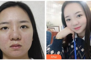 诸暨爱尔眼科医院李志强整形价格表附切开双眼皮案例展示