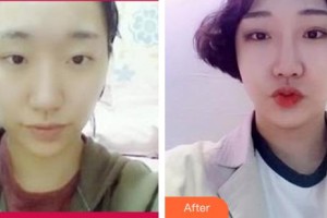 诸暨爱尔眼科医院任远望整形价格表附切开双眼皮案例展示