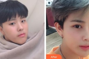 诸暨爱尔眼科医院唐静晓整形价格表附外切祛眼袋案例展示