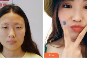 诸暨爱尔眼科医院许如安整形价格表附切开双眼皮案例展示