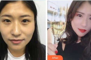 中南大学湘雅医院整形美容中心谭军整形价格表附黑脸娃娃案例展示