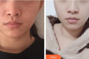 中南大学湘雅二医院烧伤整形外科王先成整形价格表附激光祛斑案例展示