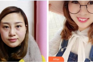 中南大学湘雅三医院烧伤整形外科贺全勇整形价格表附清洁祛痘案例展示