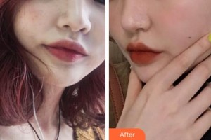 中南大学湘雅三医院烧伤整形外科罗成群整形价格表附激光祛斑案例展示