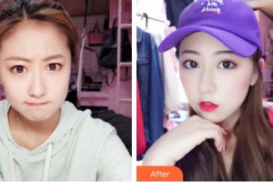 中南大学湘雅三医院烧伤整形外科朱颉整形价格表附微针水光案例展示