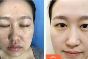 中南大学湘雅三医院烧伤整形外科徐阳成整形价格表附去痘印痘坑案例展示