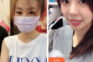 中南大学湘雅三医院烧伤整形外科周建大整形价格表附皮肤案例展示