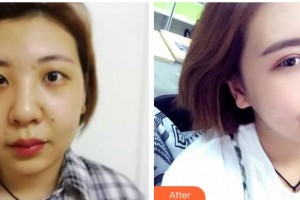 中南大学湘雅医院整形美容中心雷少榕整形价格表附光子嫩肤案例展示