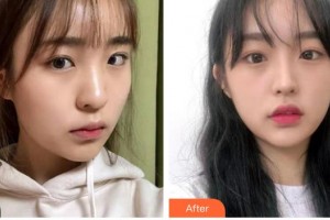 中南大学湘雅医院整形美容中心杨兴华整形价格表附水氧活肤案例展示