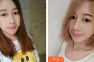 荣成眼科医院胡运韬整形价格表附切开双眼皮案例展示