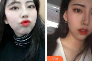 荣成眼科医院宋旭东整形价格表附切开双眼皮案例展示