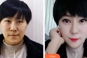 荣成眼科医院钱大伟整形价格表附上眼睑去脂案例展示