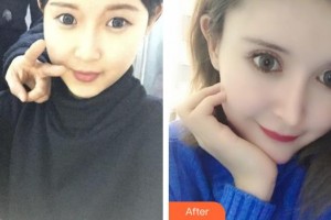 荣成眼科医院杨华强整形价格表附眼部综合案例展示