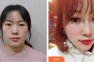 荣成眼科医院姚毅整形价格表附切开双眼皮案例展示