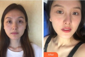 惠阳人民医院崇雅路门诊部医疗美容科何丽玲整形价格表附鼻部综合案例展示