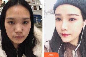 惠阳人民医院崇雅路门诊部医疗美容科刘辉良整形价格表附耳软骨复合隆鼻案例展示