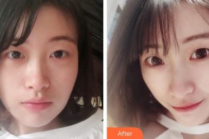 惠阳长安医院整形美容中心高慧宁整形价格表附假体隆鼻案例展示