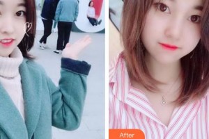 惠阳长安医院整形美容中心邹海昌整形价格表附耳软骨复合隆鼻案例展示