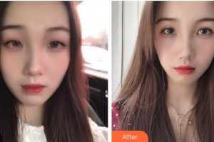 龙口光明眼科医院范慧君整形价格表附切开双眼皮案例展示